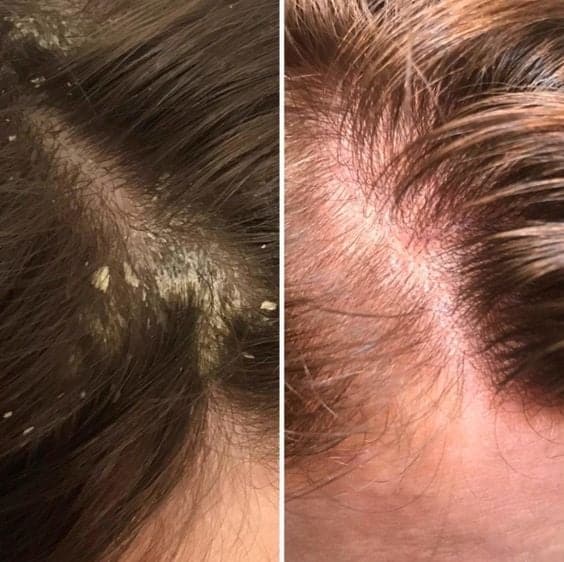 What Causes Dry Scalp and Dandruff, How do you get rid of dry scalp, why do I have dry scalp and dandruff, what causes dandruff and dry itchy scalp, is dandruff a sign of dry scalp, what is dry scalp and dandruff, why is my scalp so dry with dandruff, what can i do for dry scalp and dandruff, what can help with dry scalp and dandruff, how to get rid of dry scalp and dandruff naturally, why is there dandruff on my scalp, why do i get dandruff on my scalp, how to treat dry scalp, what causes dandruff, dandruff vs dry scalp, dry scalp treatment at home,