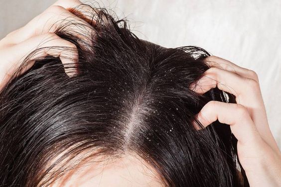 What Causes Dry Scalp and Dandruff, How do you get rid of dry scalp, why do I have dry scalp and dandruff, what causes dandruff and dry itchy scalp, is dandruff a sign of dry scalp, what is dry scalp and dandruff, why is my scalp so dry with dandruff, what can i do for dry scalp and dandruff, what can help with dry scalp and dandruff, how to get rid of dry scalp and dandruff naturally, why is there dandruff on my scalp, why do i get dandruff on my scalp, how to treat dry scalp, what causes dandruff, dandruff vs dry scalp, dry scalp treatment at home,