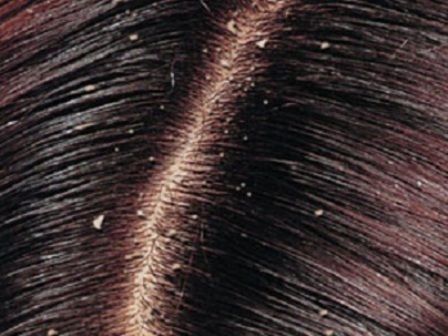 What Causes Dry Scalp and Dandruff, How do you get rid of dry scalp, why do I have dry scalp and dandruff, what causes dandruff and dry itchy scalp, is dandruff a sign of dry scalp, what is dry scalp and dandruff, why is my scalp so dry with dandruff, what can i do for dry scalp and dandruff, what can help with dry scalp and dandruff, how to get rid of dry scalp and dandruff naturally, why is there dandruff on my scalp, why do i get dandruff on my scalp, how to treat dry scalp, what causes dandruff, dandruff vs dry scalp, dry scalp treatment at home,